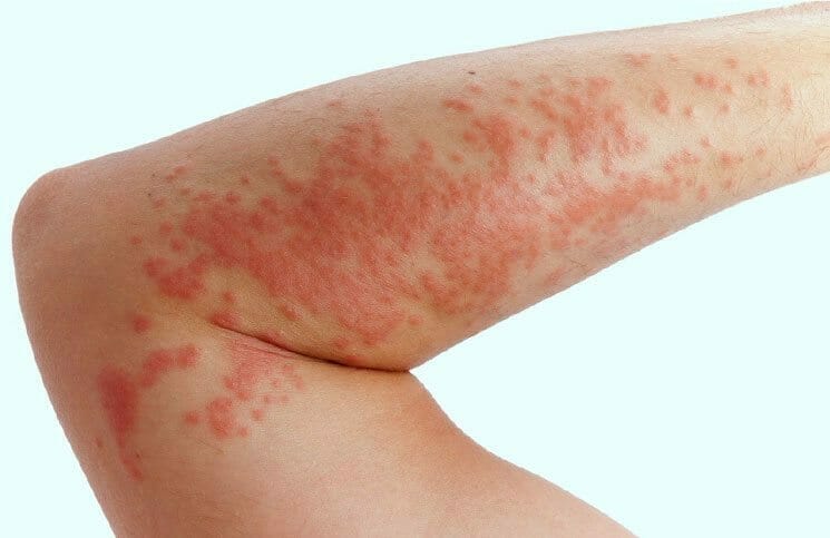 essential oils for hives Which essential oils helps with hives?